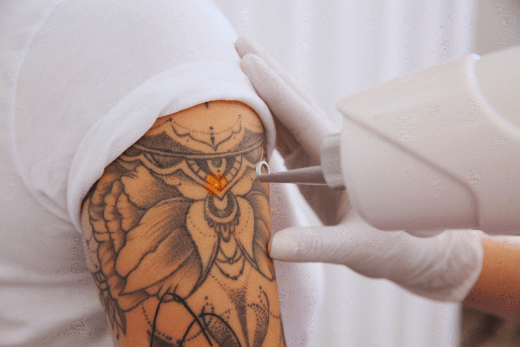 Remoção a laser de tatuagem