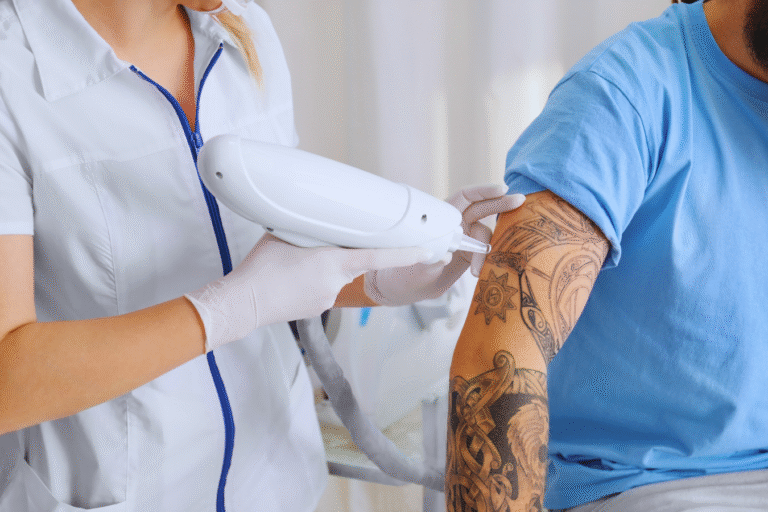 remoção a laser de tatuagem