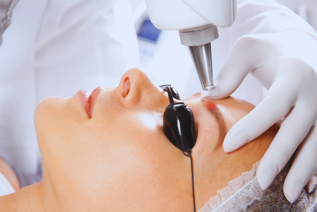remoção de micropigmentação a laser